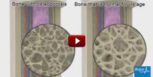 How osteoporosis develops